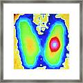 Coloured Gamma Scan Of Benign Thyroid Adenoma Framed Print