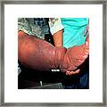 Swollen Leg Of Elephantiasis Patient Framed Print