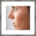 Portrait Of A Woman With Melanoma Moles And Freckles (xxxl) #1 Framed Print