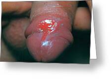 Painful ulcers on the penis