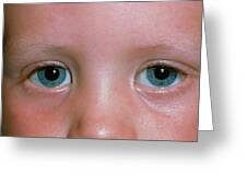 Epicanthic Folds On The Eyes Of A Young Child Photograph By Dr P