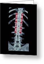 Broken backbone, illustration - Stock Image - C036/3987 - Science Photo  Library