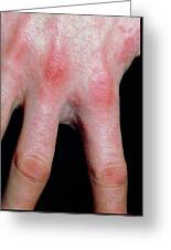 Scabies Infection On The Hand And Fingers Photograph by Dr H.c.robinson /  Science Photo Library - Fine Art America