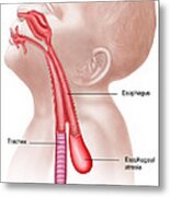 Anatomy Of A Tracheoesophageal Fistula #1 Metal Print