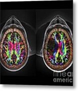 Brain Cancer, Dti And 3d Ct Scans #1 Metal Print