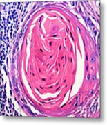 Squamous Cell Carcinoma, Keratin Pearl #2 Metal Print