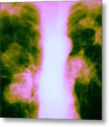 Tuberculosis Infection #1 Metal Print