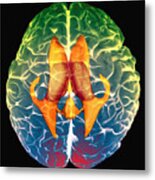 Ventricles Of Brain #1 Metal Print