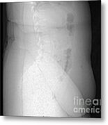 X-ray Of Morbidly Obese Patient #1 Metal Print