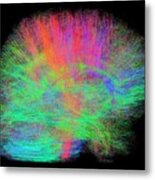 White Matter Fibres Of The Human Brain #10 Metal Print