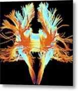White Matter Fibres Of The Human Brain #12 Metal Print