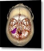 Brain Tumour #13 Metal Print