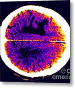 Brain Edema #2 Metal Print