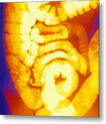 Large And Small Intestine, Barium X-ray #2 Metal Print