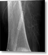 Leg Artery Angioplasty #2 Metal Print