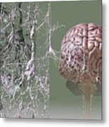 Alzheimer's Disease #3 Metal Print