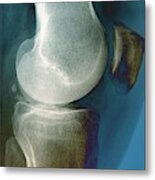 Calcification In The Knee #3 Metal Print