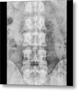 Dens Fracture. Cervical Spine X-ray #3 Metal Print