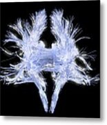 White Matter Fibres Of The Human Brain #28 Metal Print