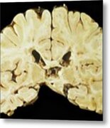 Brain In Multiple Sclerosis Metal Print