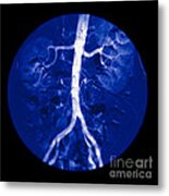 Color Enhanced Aortogram & Renal Metal Print