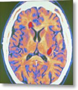Coloured Mri Scan Of Brain In Multiple Sclerosis Metal Print
