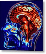 Coloured Mri Scan Of Brain In Sagittal Se Metal Print