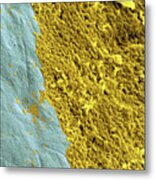 Coloured Sem Of A Dental Plaque Seen On A Tooth Metal Print