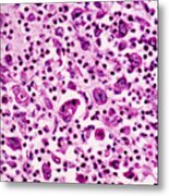 Giant-cell Carcinoma Of The Lung, Lm Metal Print