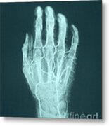 Hand Arteriogram Metal Print