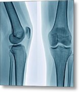 Healthy Knee, X-ray Metal Print