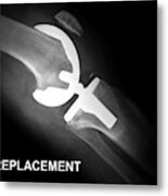 Knee Replacement, X-ray Metal Print