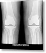 Knees After Replacement Surgery Metal Print