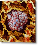 Lung Cancer, Close-up Metal Print