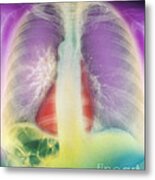 Lung Cancer, X-ray Metal Print