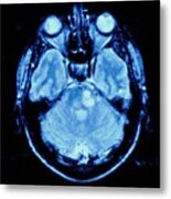 Mri Scan Of A Brain With Multiple Sclerosis Metal Print