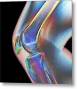 Normal Knee, X-ray Metal Print