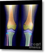 Normal Pediatric Legsknees, X-ray Metal Print