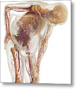 Overweight Body And Circulatory System Metal Print