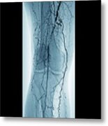 Peripheral Vascular Disease In Diabetes Metal Print