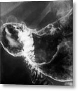 Stomach Cancer Metal Print