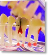 Tooth Disorders Metal Print
