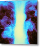 Tuberculosis Infection Metal Print