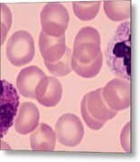 Two White Blood Cells Or Leukocytes--neutrophil (right) And Eosinophil (left), Human Blood Smear, 500x Metal Print