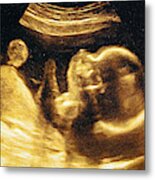 Ultrasound Of A Woman's Fetus At 37 Weeks Metal Print
