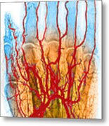 Hand Arteriogram #3 Metal Print