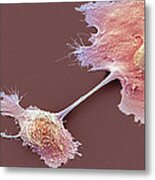 Pancreatic Cancer Cells, Sem #3 Metal Print