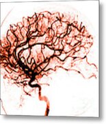 Cerebral Angiogram Metal Print