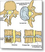 Illustration Of Spinal Disk Pathologies #9 Metal Print