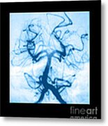 Angiogram Of Embolus In Cerebral Artery Metal Print